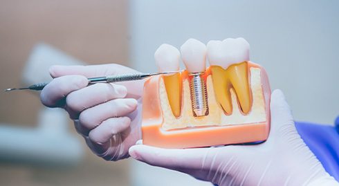 White-gloved hands pointing to crown of sample dental implant