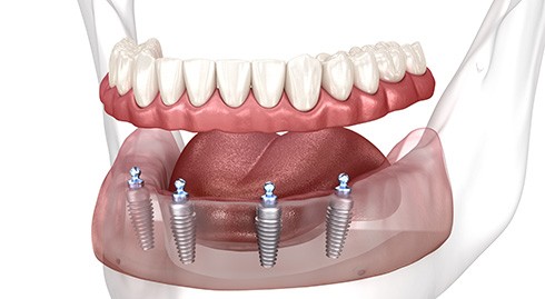 Full set of dentures polished to a shine on a white background