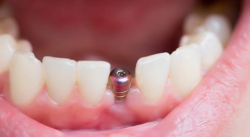 patient smiling with implant in mouth