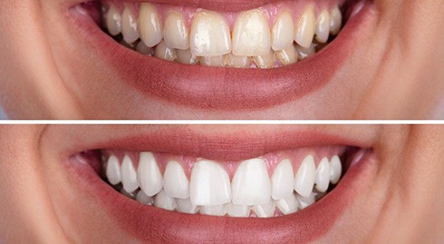 a before/after photo showing teeth whitening results