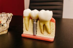 Model of single tooth dental implant